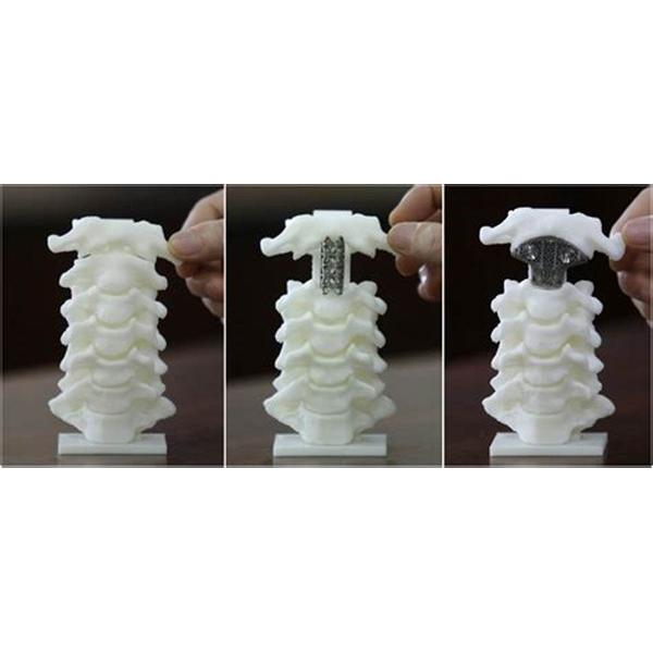 Spinal Fusion Cornerstone Peek Cage Titanium Mesh OEM / ODM Service