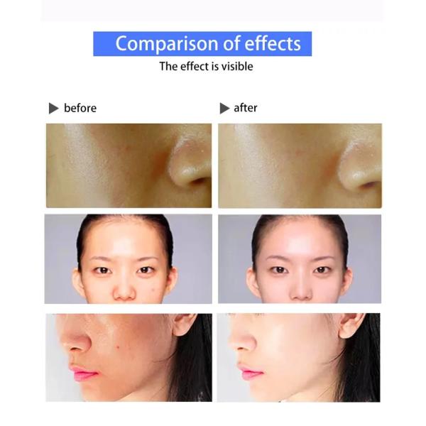 3 In 1 Acne Removal Eyelid Face Plexer Plasma Jett Skin Lifting Machine Cold And Hot Therapy Radio Frequency