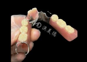 China Titantium Cast Partial Dentures With Clasps Rests Along With Teeth Set Up on sale