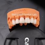 Comfort and Function with Digital CAD CAM Dental Lab Translucent Layered