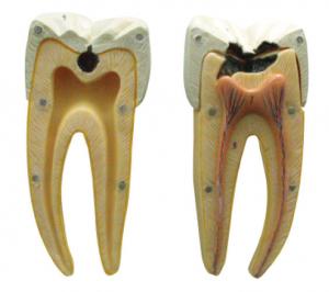 Quality In Initial And Advanced Stages Of Dental Caries Model For Learning And Training for sale