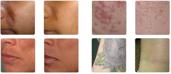 effective freckles removal 600 ps pico second laser for pico laser tattoo removal