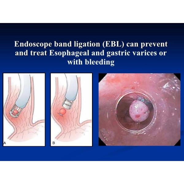 Ligatures endoscopic loop of variceal bands