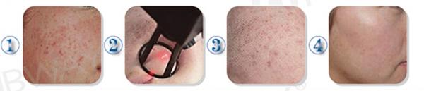Laser Offer Skin rejuvenation/Scar Removal Machine/RF Fractional CO2 Laser