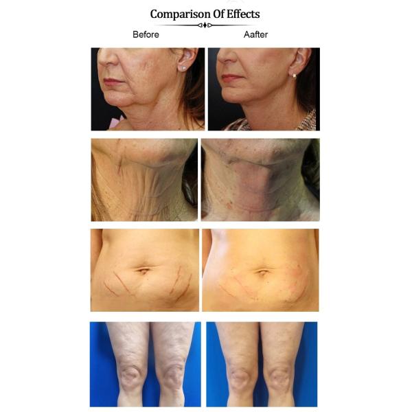 Pdo Thread 21g*90mm Cog 3d with L Type Cannula Pdo Thread Cog Korea