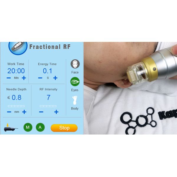 Strectch Marks Removal 45 Degree Microneedling Frational RF