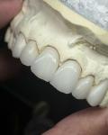 Transluency Layered Zirconia Crown for Optimal Functionality and Natural