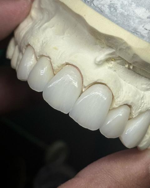 Transluency Layered Zirconia Crown for Optimal Functionality and Natural
